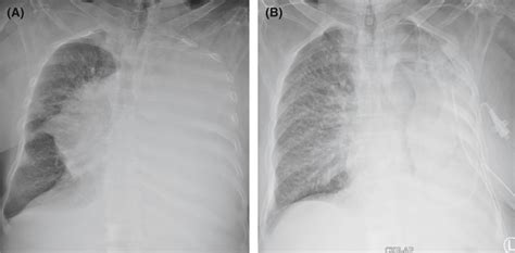 Chest x‐ray shows A, complete left lung consolidation and B, control... | Download Scientific ...