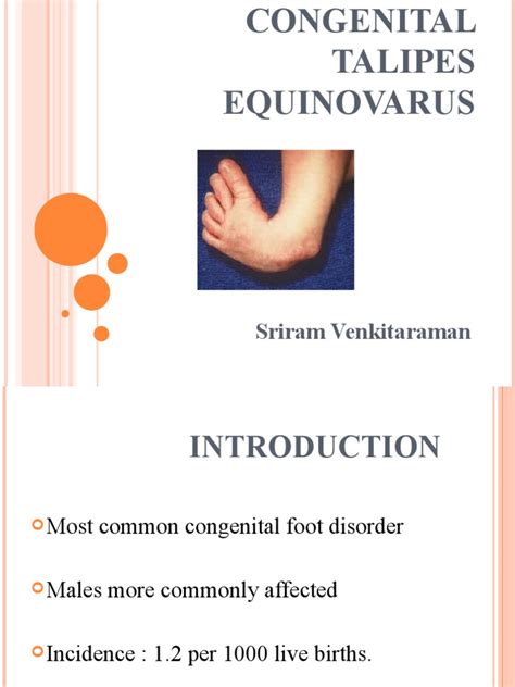 Congenital Talipes Equinovarus Final