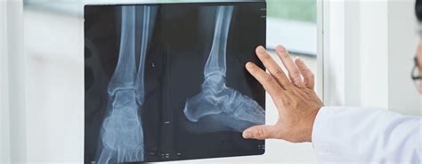 Ankle Fracture Recovery | Orange County Foot and Ankle Doctor