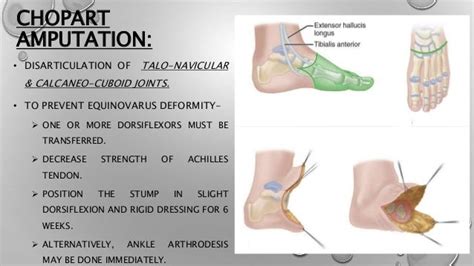 Lower limb amputation