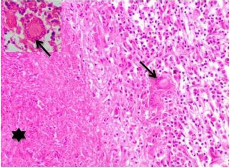 Mediastinal lymph node: the granuloma was consists of a central area of ...