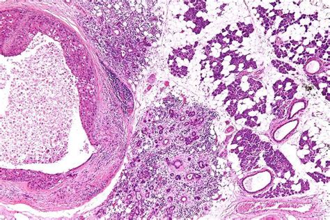 Salivary duct carcinoma - Alchetron, the free social encyclopedia