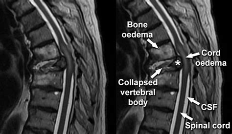 MRI Gallery - MRI T-spine - Cord compression