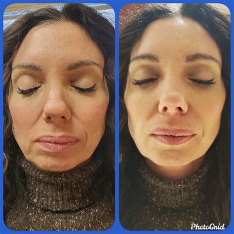 My Experience getting Smile Line Filler