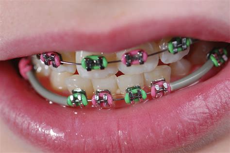 Turning Your Braces into a Fashion Statement | Dunn Orthodontics