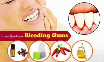 21 Effective Home Remedies For Bleeding Gums While Brushing