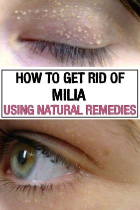 How to Get Rid of Milia Using Natural Remedies - iwomenhacks