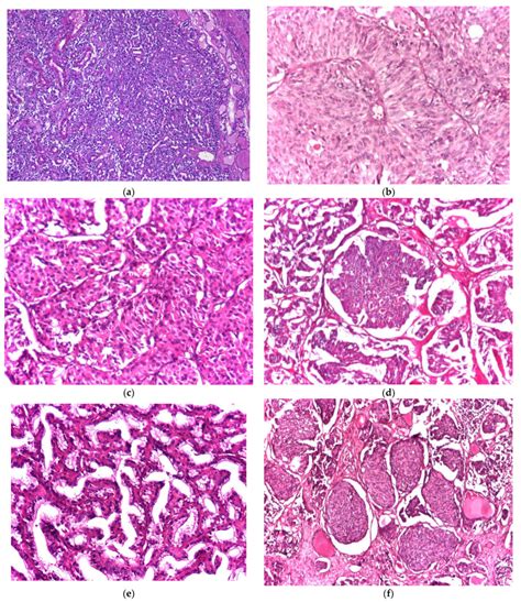 (a–e) Histological variants of medullary thyroid carcinoma: (a)... | Download Scientific Diagram