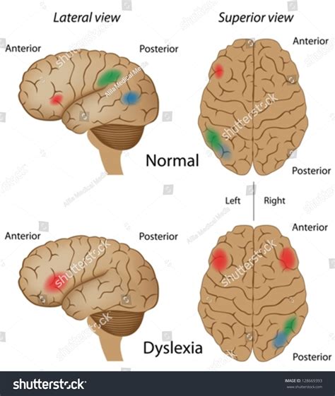 Dyslexia Brain Activity Stock Vector 128669393 - Shutterstock