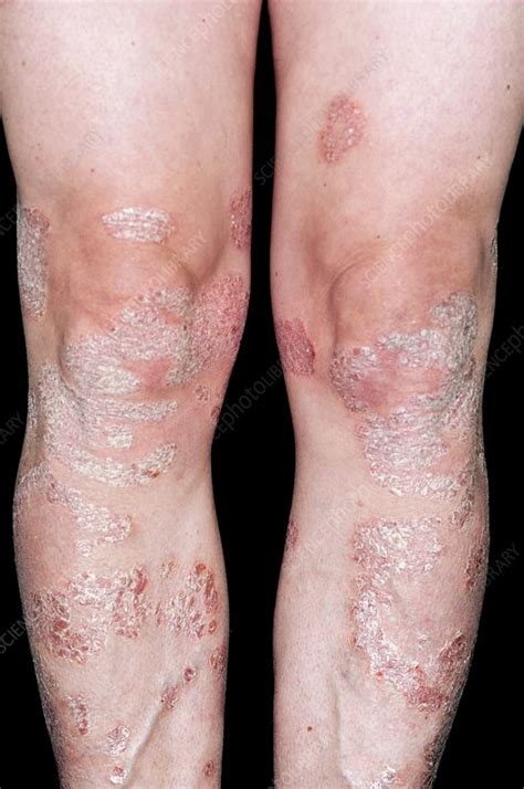 Plaque psoriasis on the legs - Stock Image - C011/7477 - Science Photo Library