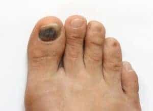 Blood Blister on Foot | Beaver Valley Foot Clinic