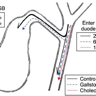 Endoscopic view of remnant gastropathy due to bile reflux | Download ...