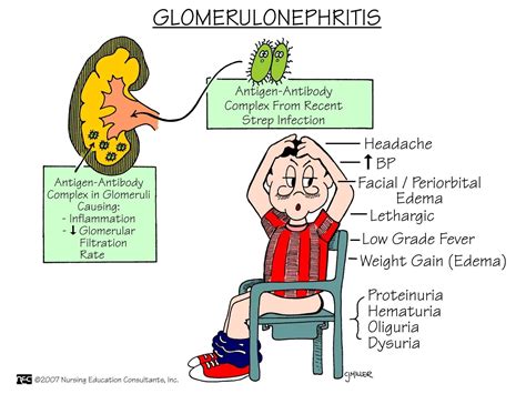 Glomerulonephritis | Nursing mnemonics, Medical surgical nursing, Nursing school survival