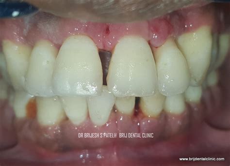 Laser Dental Treatment- Gums, Cavities, Minor Surgeries, RCT in ...