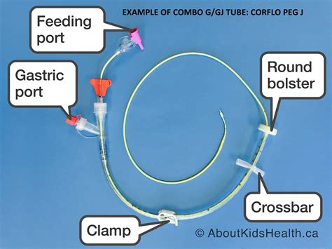 HINT: Do you know what type of enteral feeding tube the child has? — Connected Care @ SickKids