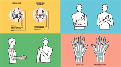 How To Control Arthritis Pain - Sinkforce15