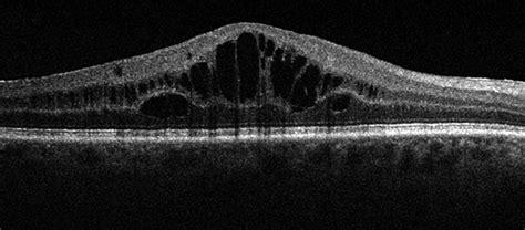 Optical coherence tomography imaging of macular oedema | British Journal of Ophthalmology