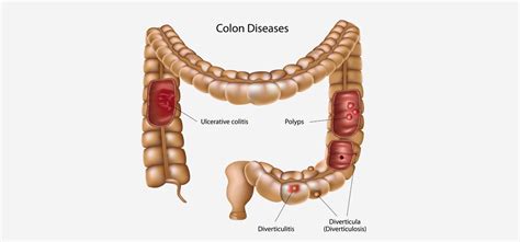 Bright red blood in stool diverticulitis: Diverticular Bleeding | Cigna