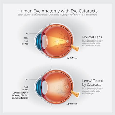 Early Onset Cataracts: Signs, Causes, Treatment of Premature Cataracts