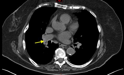 What Is A Ct Scan With Contrast For Chest