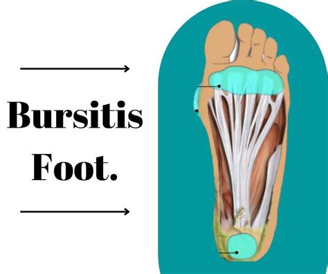 Bursitis Foot | The Prolotherapy Clinic