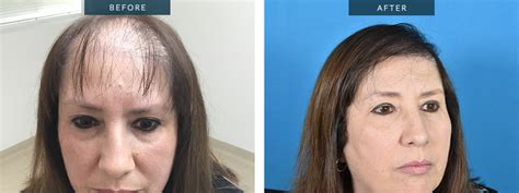 Hair Transplant for Women | Female Baldness Treatment