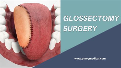 Glossectomy Surgery Price in the Philippines 2024 — PinoyMedical