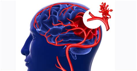 Brain Aneurysm: Causes, Symptoms, Diagnosis & Treatment