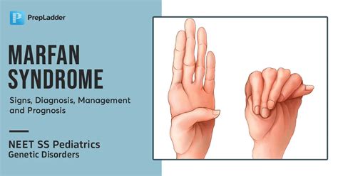 Marfan Syndrome : Signs, Diagnosis, Management and Prognosis
