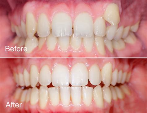 clear-aligners-before-after-2-AdobeStock_573993958 - Lansdowne, VA Family Dentistry