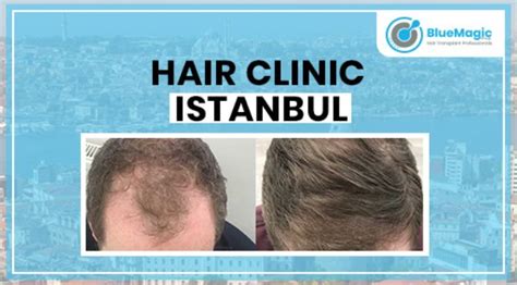 Best Hair Transplant Clinic in Istanbul | Blue Magic