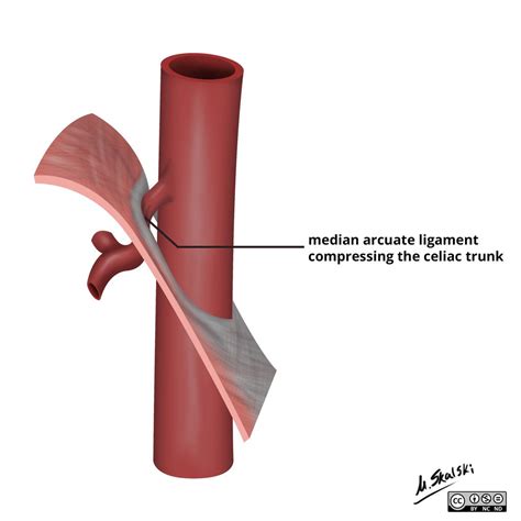 http://radiopaedia.org/cases/median-arcuate-ligament-syndrome-5 ...