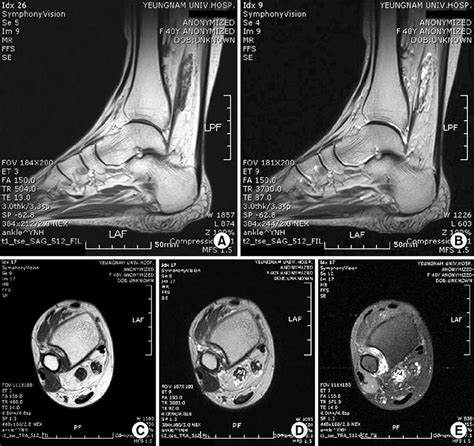 MRI sagital plane (A) T1weighted image showed heterogenous mass lesion ...