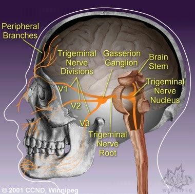 Your Complete Guide to Trigeminal Neuralgia; A. M. Kaufmann & M. Patel, CCND Winnipeg