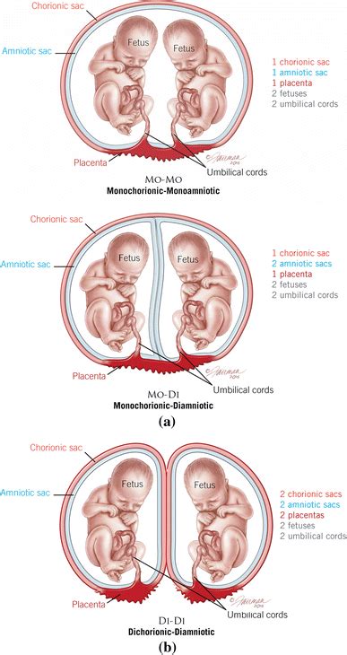 a Monochorionic-monoamniotic twins (MCMA, shown in the top image) have... | Download Scientific ...