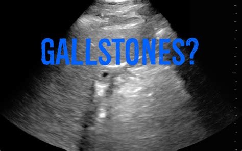 Hennepin Ultrasound | Gallstones?