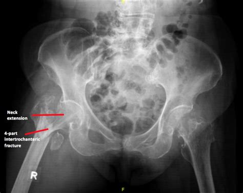 Pre-operative X-ray of antero-posterior view of pelvis showing a... | Download Scientific Diagram