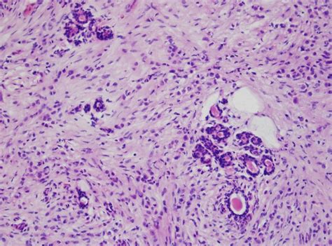 Invasive Lobular Carcinoma