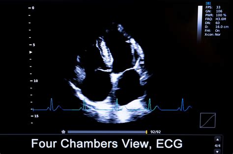 Get Your Best APICAL 4 Chamber View with POCUS - Point-of-Care Ultrasound Certification Academy