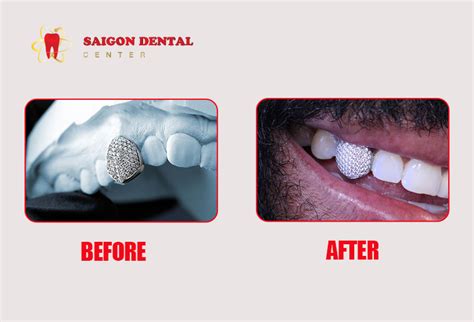 All About Diamond Teeth: Advantage - Procedure - Before After Image ...