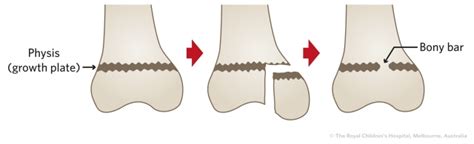 Fracture Education : Physeal (growth plate) injuries