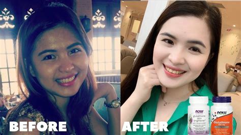 GLUTATHIONE BEFORE AND AFTER: How to whiten skin in 2023 | Glutathione, Glutathione before and ...