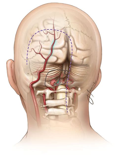 Occipital artery to posterior inferior cerebellar artery bypass - Neurosurgery Blog