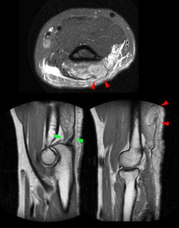 Distal Triceps Injuries - Radsource