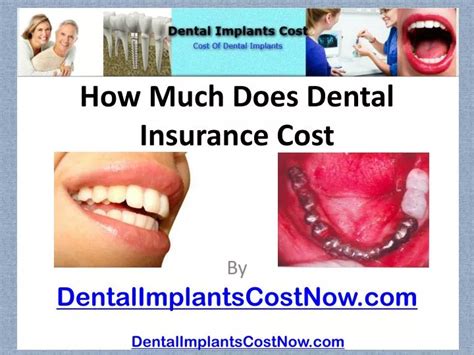 PPT - [How Much Does Dental Insurance Cost] PowerPoint Presentation ...