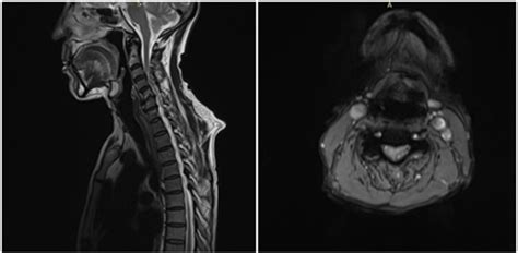 Uncommon cause of cervicobrachial neuralgia: epidural abscess complicating tuberculous arthritis ...