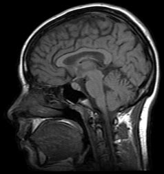 Microvascular Ischemic Disease Symptoms and Treatments | New Health Advisor