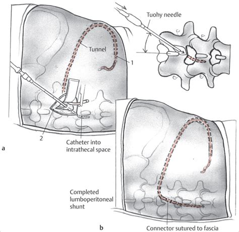 20 Lumboperitoneal Shunt | Neupsy Key