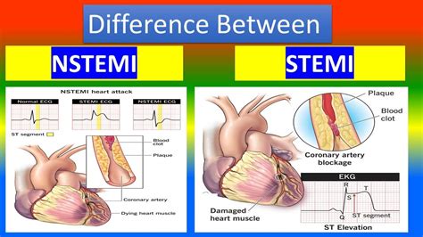 Contrast between NSTEMI and STEMI - YouTube