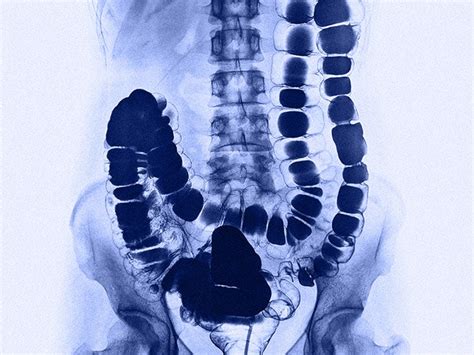 X-rays and imaging techniques for ulcerative colitis